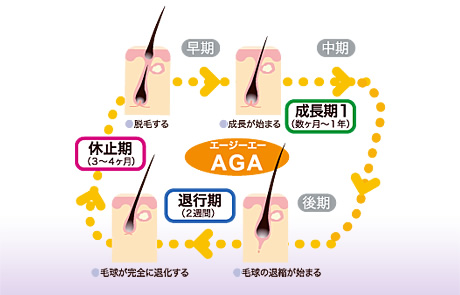 AGAの原因